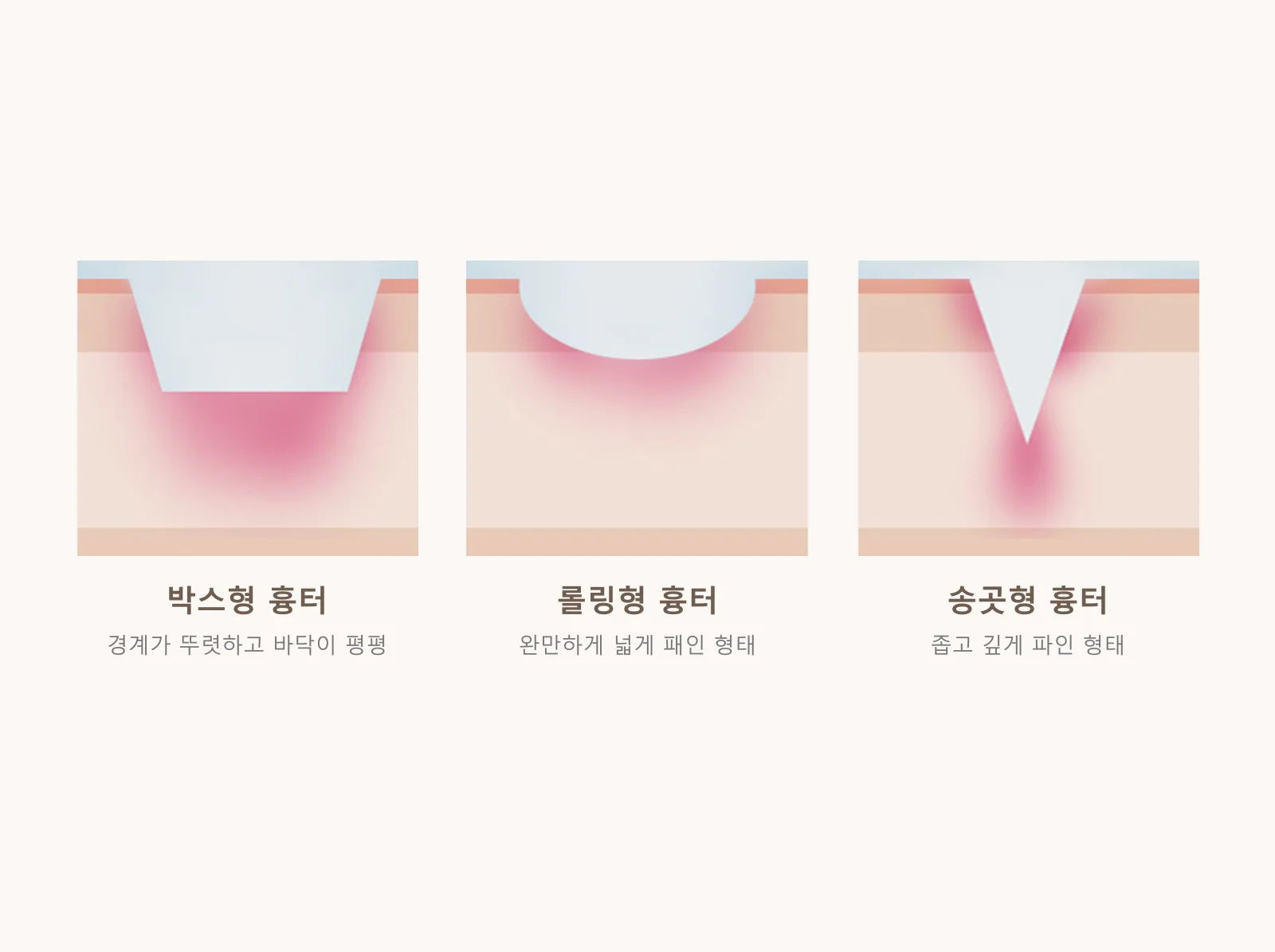 여드름 흉터의 종류 — 박스형·롤링형·송곳형 흉터 단면 그림
