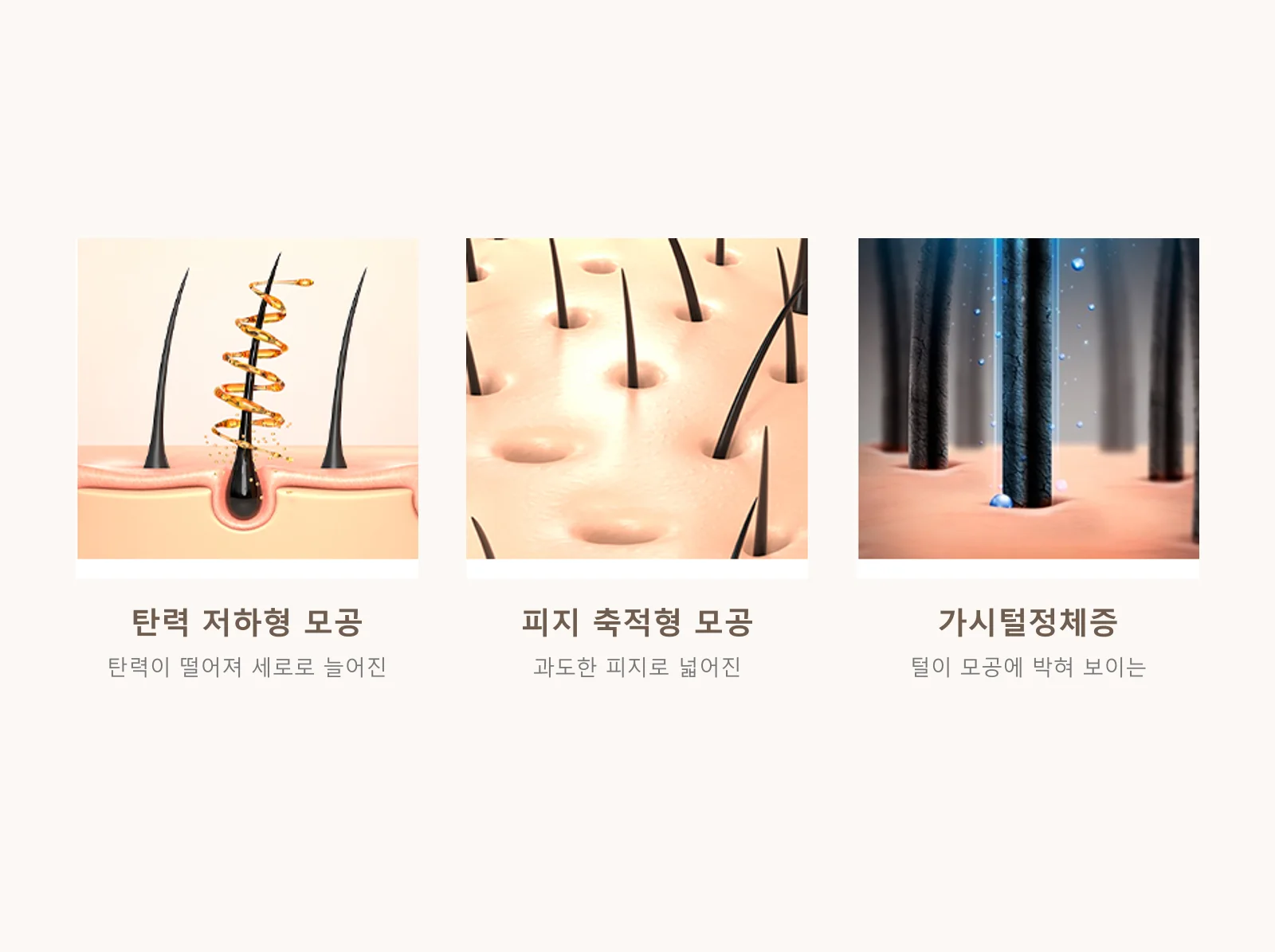 모공의 종류 — 탄력 저하형 모공·피지 축적형 모공·가시털정체증 그림