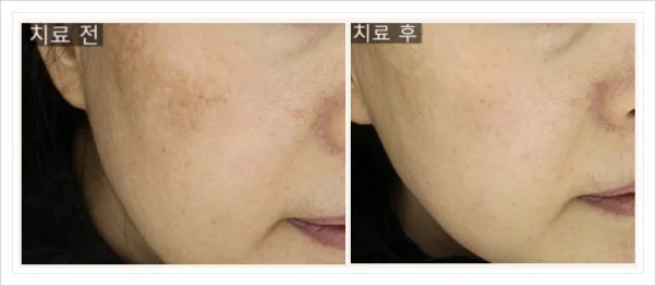 레이저 시술을 통한 기미 및 색소 치료 전후 비교 사진